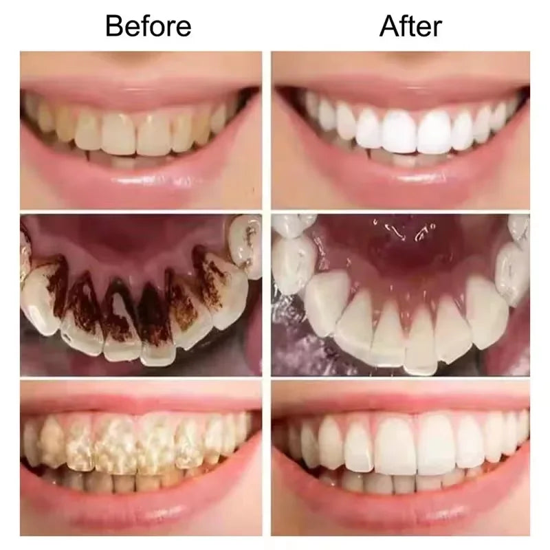 V34 Teeth Remove Plaque