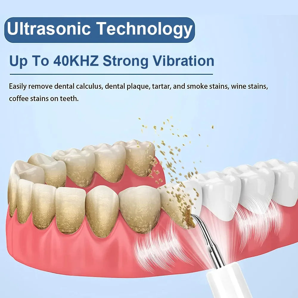 Ultrasonic Dental Whitening